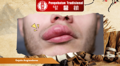 Gejala Angioedema: Peringatan Dini Pembengkakan Berbahaya