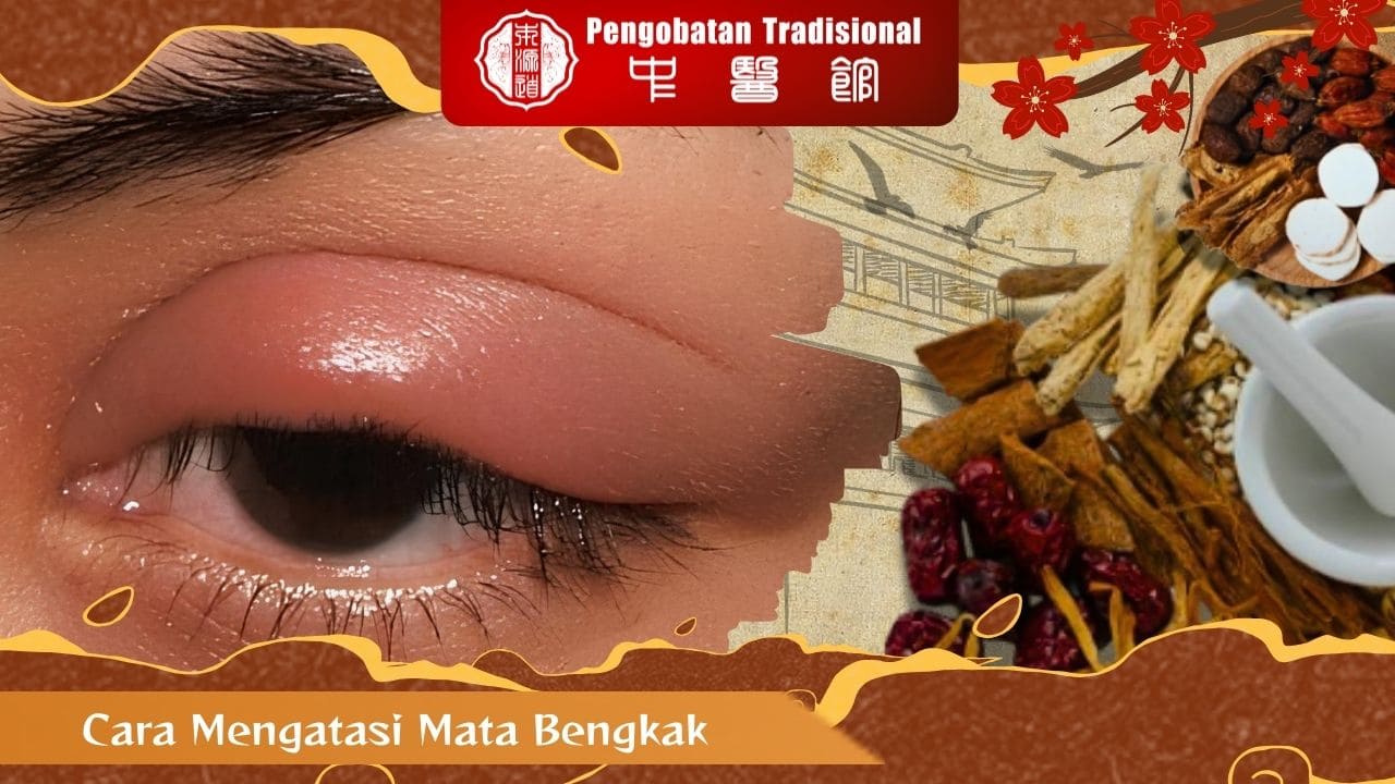 Cara Mengatasi Mata Bengkak dengan Metode TCM