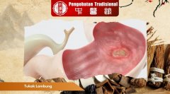 Meredakan Tukak Lambung dengan Obat Alami, Intip Disini!