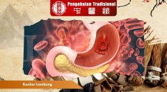 Mengenal Kanker Lambung: Gejala, Penyebab, Pencegahan