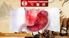 Benarkah GERD Pemicu Kanker Lambung? Ini Penjelasannya